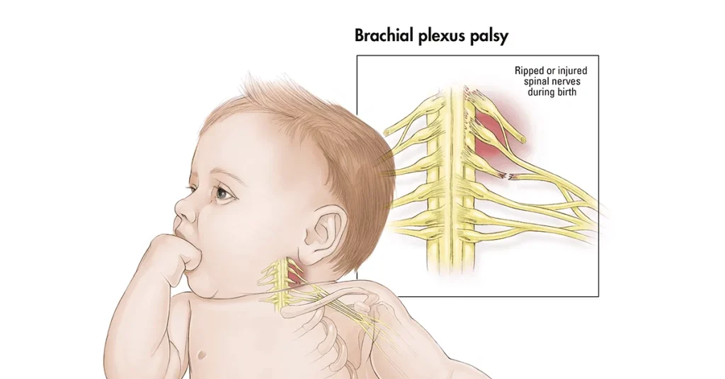 Brakial Pleksus Rehabilitasyonu